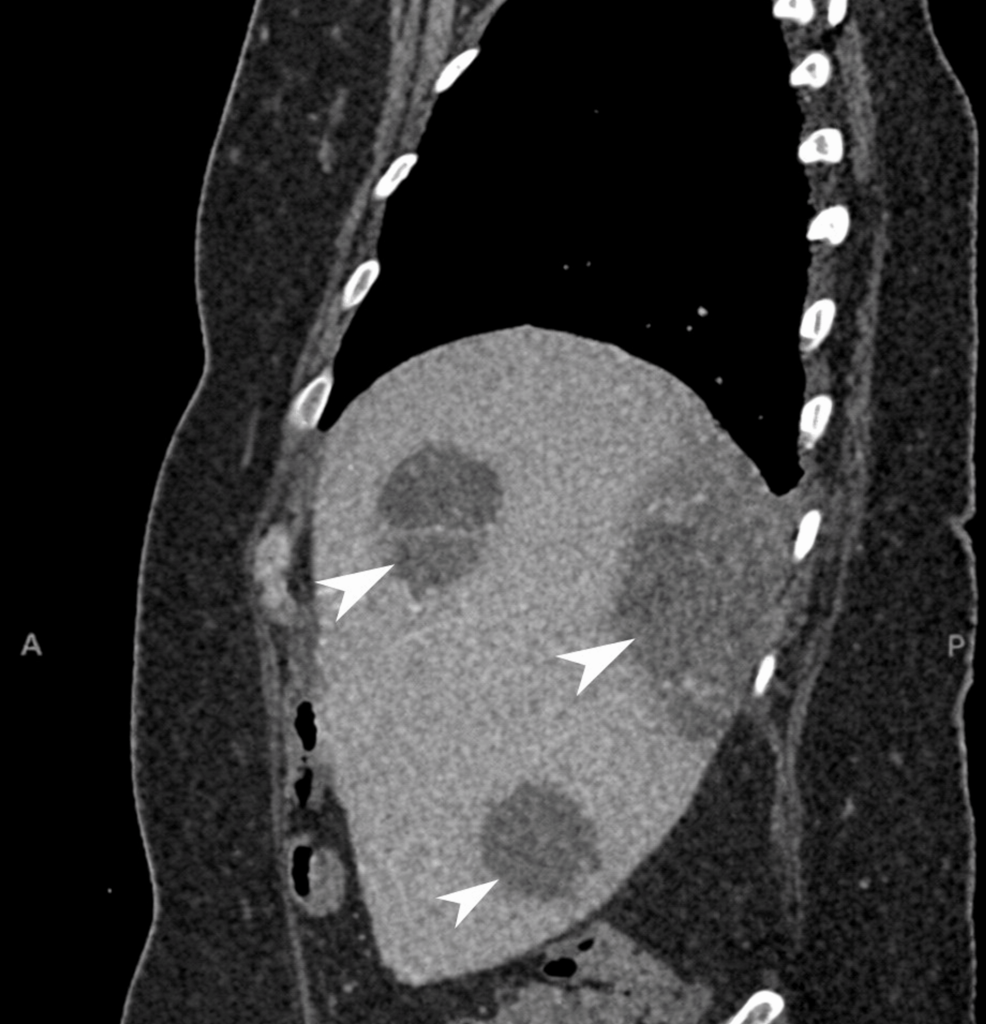 Cryptogenic Pyogenic Liver Abscess as a Sentinel of Occult Colorectal Cancer: Successful Conservative Management of a Rare Presentation