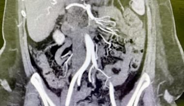 Venous Ischemic Pancreatitis With Reduced Pancreatic Enzymes Secondary to Extensive Splanchnic Venous Thrombosis: An Unrecognized Vascular Phenotype
