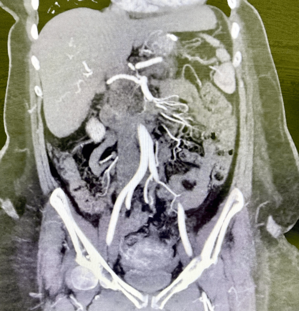 Venous Ischemic Pancreatitis With Reduced Pancreatic Enzymes Secondary to Extensive Splanchnic Venous Thrombosis: An Unrecognized Vascular Phenotype