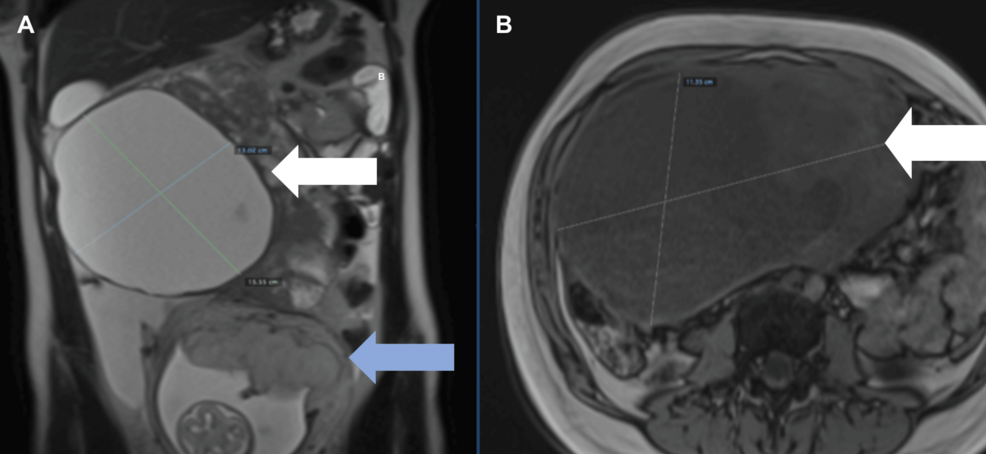 Epithelial Ovarian Cancer With Cardiac Metastases in Pregnancy: A Case Report