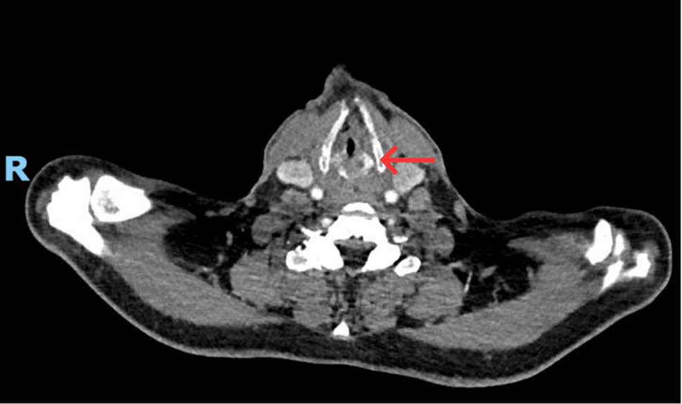 Acute Upper Airway Obstruction Induced by Nasogastric Tube Syndrome During the Management of a Bowel Obstruction
