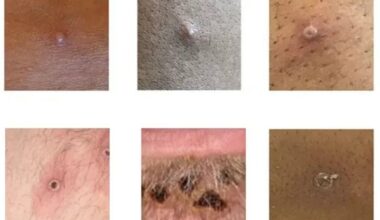 Denmark reports 1st mpox variant clade 1b case