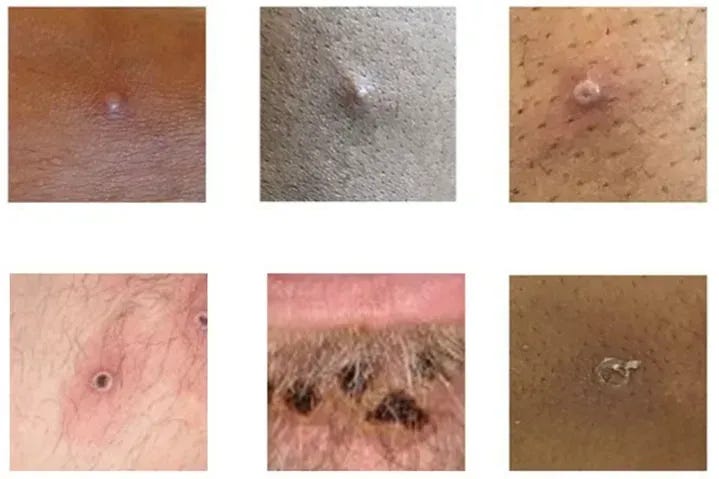 Denmark reports 1st mpox variant clade 1b case