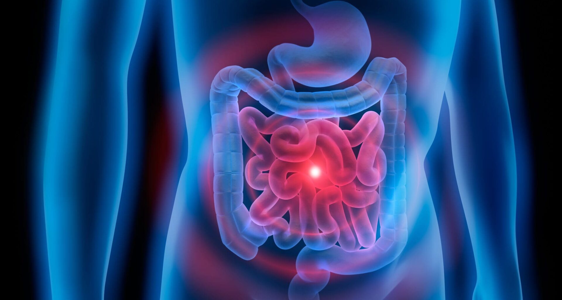 Medical Illustration of colon problems