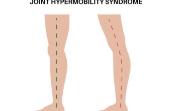 Stay Well: My ‘double-jointedness’ is down to hypermobility. What is it and will it cause me any issues?