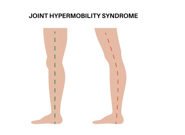 Stay Well: My ‘double-jointedness’ is down to hypermobility. What is it and will it cause me any issues?