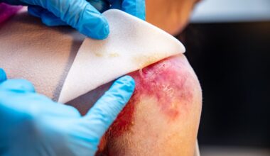 Rare skin condition patients gain access to new treatment