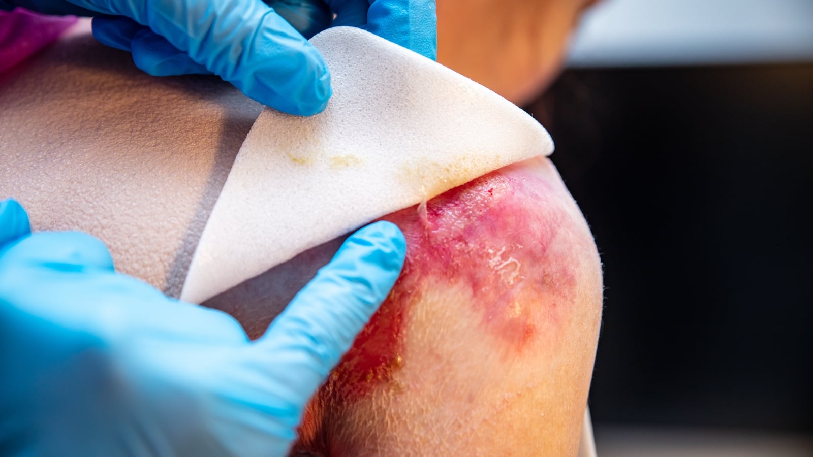Rare skin condition patients gain access to new treatment