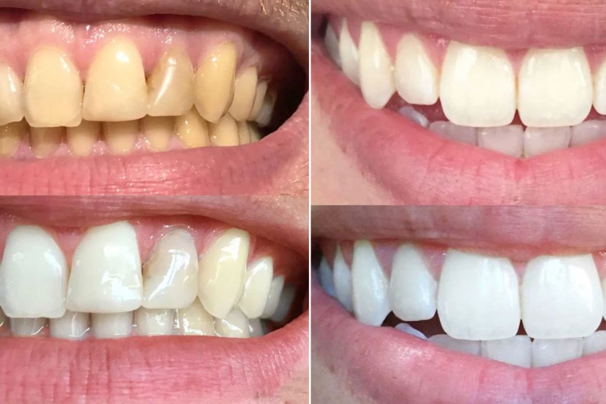 Before and after using the SmilePro teeth whitening kit with the top two sets looking yellow and the bottom two sets looking white