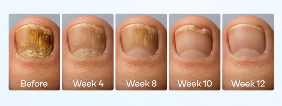 Dermavia+ says results should start to be seen within 2-4 weeks
