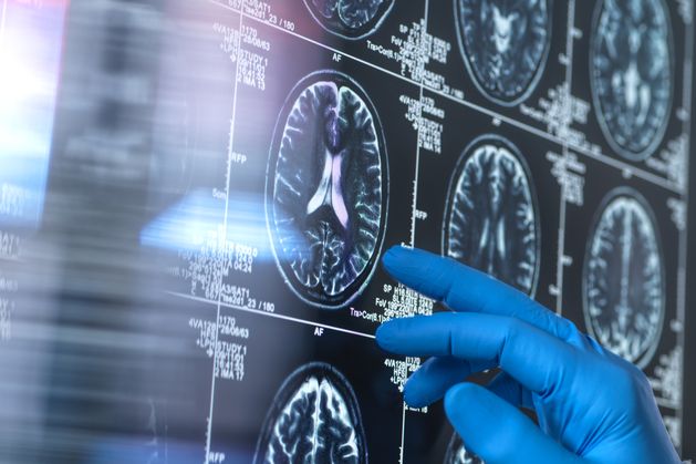 Treatment to slow Alzheimer’s approved, but €60,000 yearly price not covered by HSE or insurance