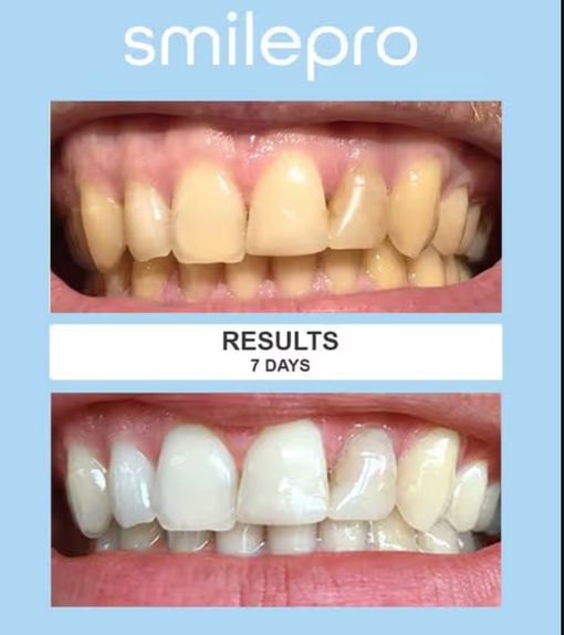 Smile Pro results