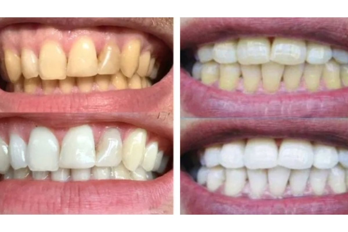 Before and after 