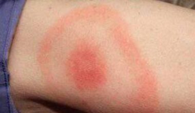 HSE warns of 'several hundred' Lyme disease detections a year 
