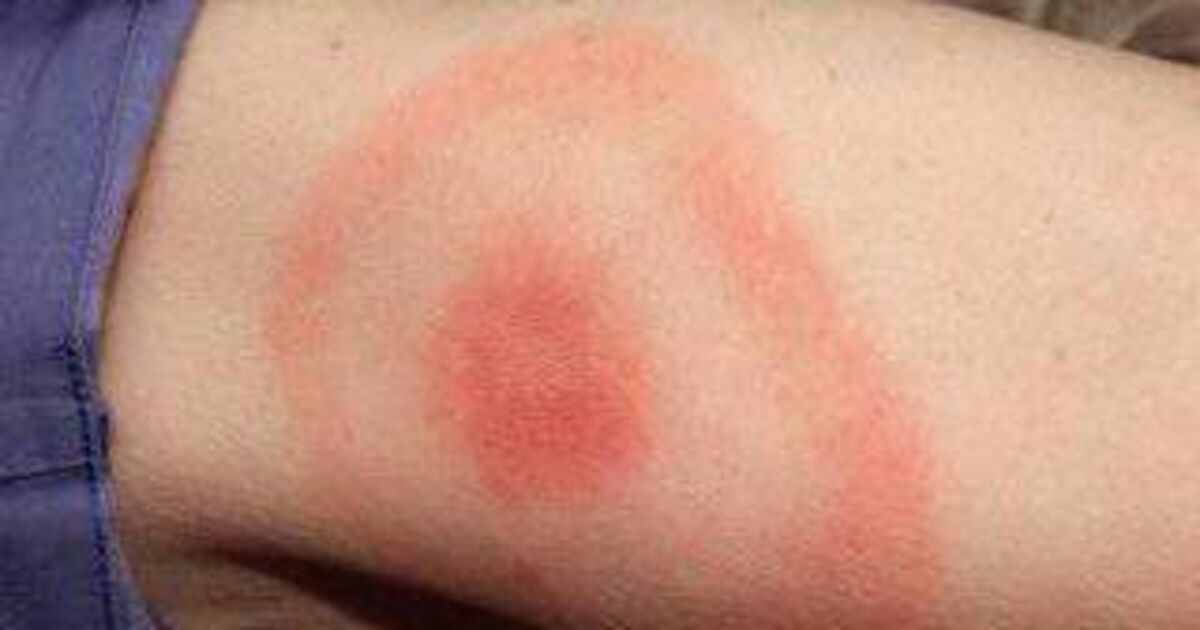HSE warns of 'several hundred' Lyme disease detections a year 