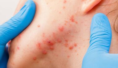 Dealing with adult acne? What you need to know to treat break-outs