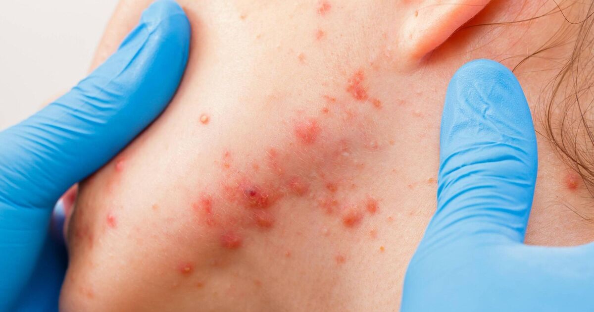 Dealing with adult acne? What you need to know to treat break-outs