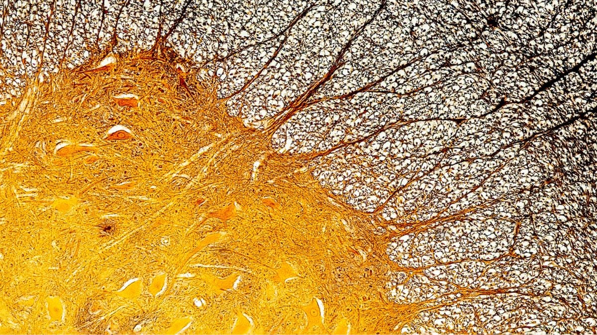 World MS Day: Immune Cell Discovery Might Explain Multiple Sclerosis at Its Worst : ScienceAlert