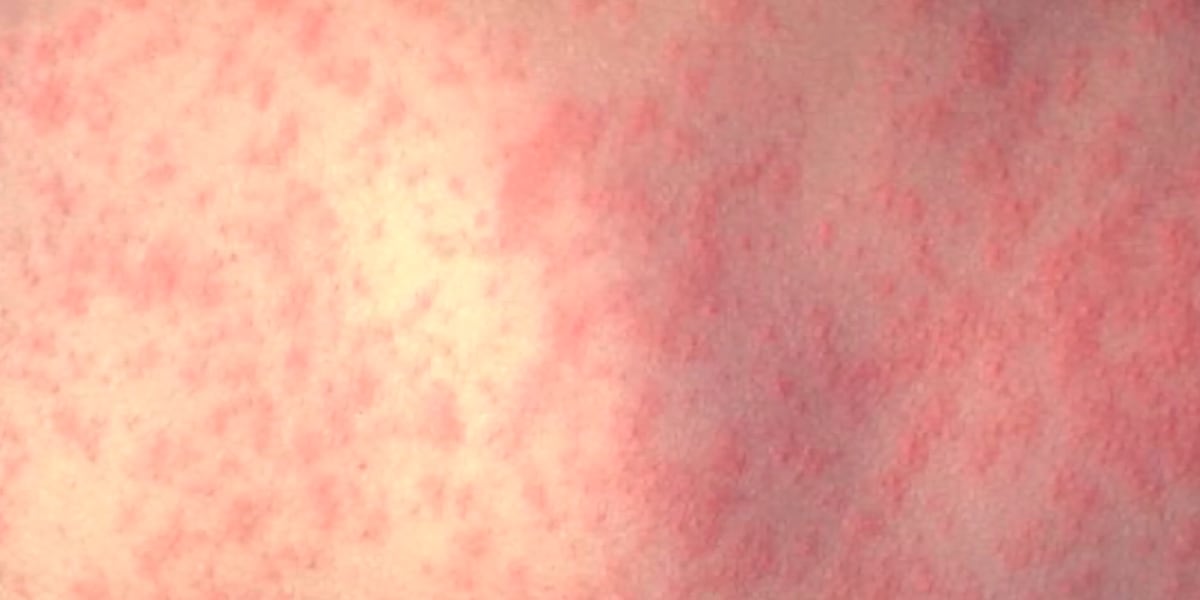 VDH reports measles case at St. Mary’s Hospital