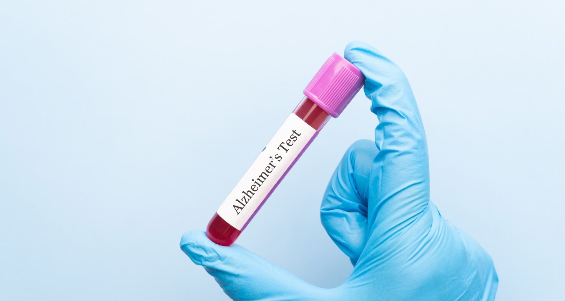 Blood sample tube with Alzheimer test label on medical laboratory technologist hands over blue background