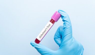 Blood sample tube with Alzheimer test label on medical laboratory technologist hands over blue background