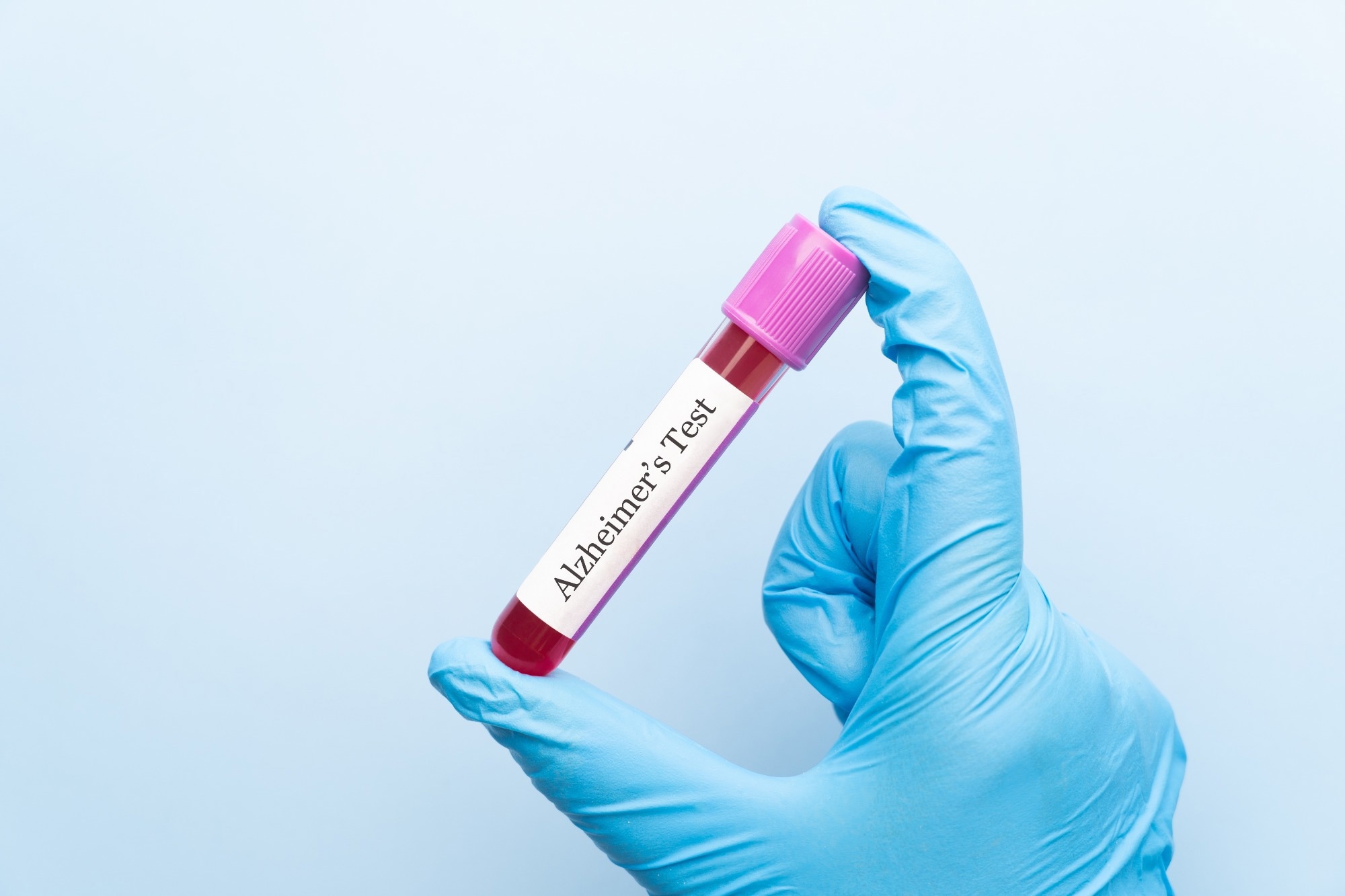 Blood sample tube with Alzheimer test label on medical laboratory technologist hands over blue background