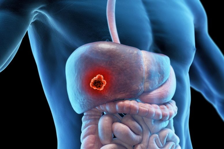 Liver Cancer Male Anatomy
