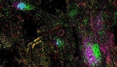 Spatial organization of TLSs within the tumor microenvironment. Image shows TLSs containing T cells (green), B cells (pink), and follicular dendritic cells (cyan), surrounded by tumor cells (red) and stromal cells (yellow). [The University of Texas MD Anderson Cancer Center]