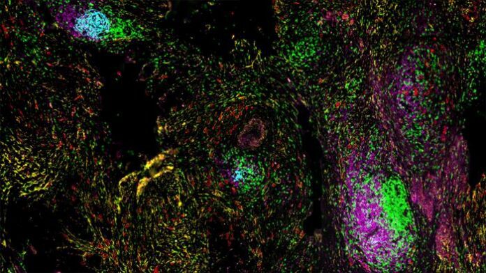 Spatial organization of TLSs within the tumor microenvironment. Image shows TLSs containing T cells (green), B cells (pink), and follicular dendritic cells (cyan), surrounded by tumor cells (red) and stromal cells (yellow). [The University of Texas MD Anderson Cancer Center]