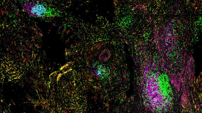 Spatial organization of TLSs within the tumor microenvironment. Image shows TLSs containing T cells (green), B cells (pink), and follicular dendritic cells (cyan), surrounded by tumor cells (red) and stromal cells (yellow). [The University of Texas MD Anderson Cancer Center]
