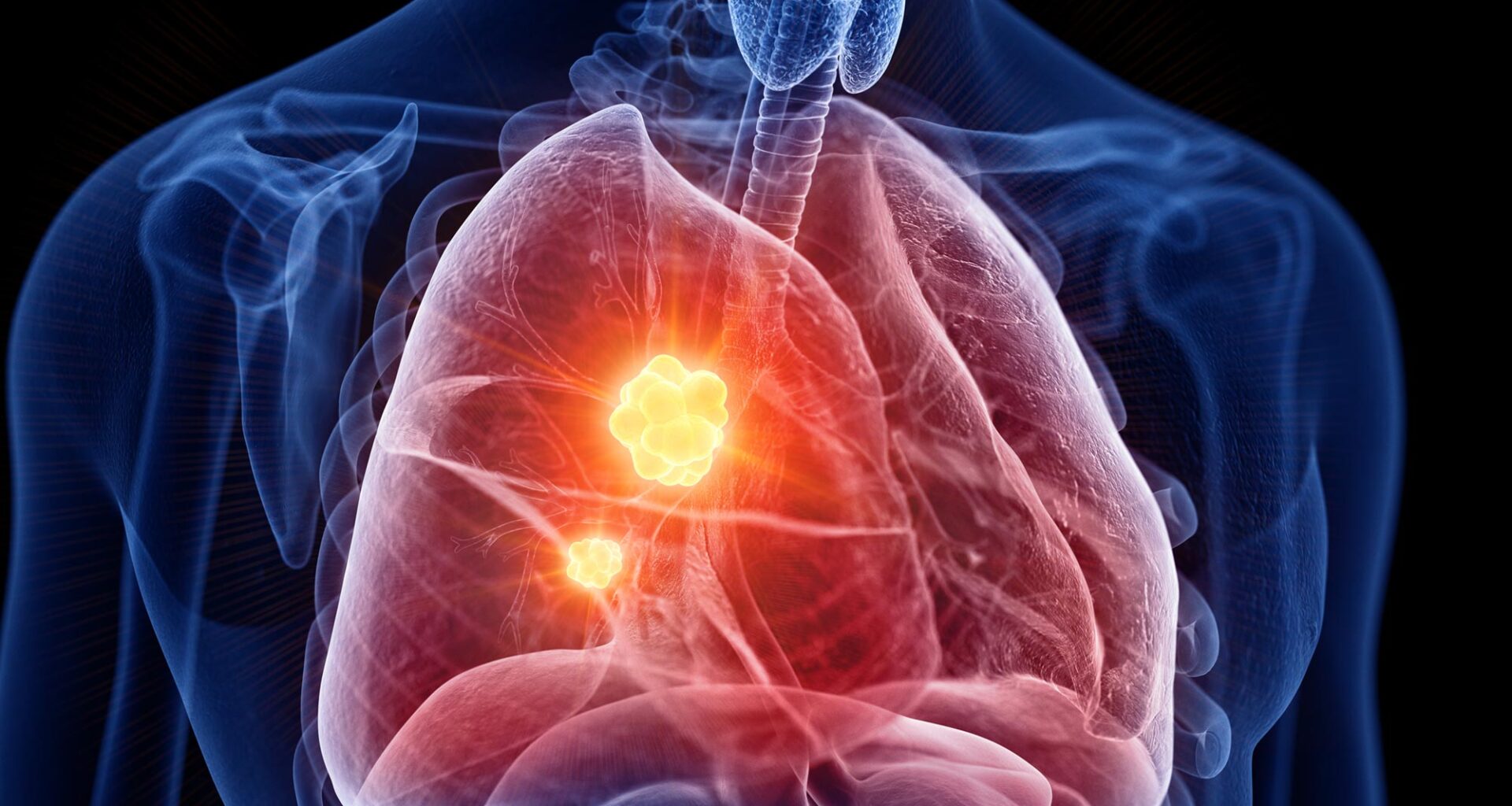 Lung Cancer Tumor Disease Anatomy Close