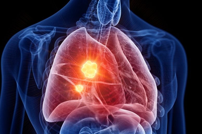 Lung Cancer Tumor Disease Anatomy Close