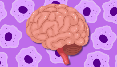 Clinical Trial Assessing MSCs in Mild Alzheimer's Disease