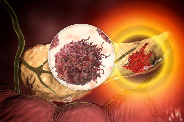 Pancreatic Cancer Malignant Tumor Cell Inset