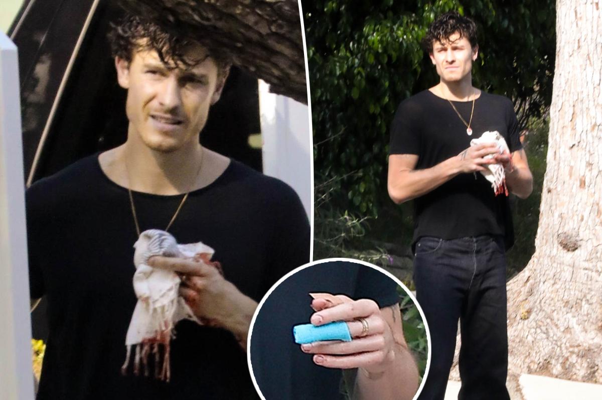 Gruesome pics show Shawn Mendes with bloody hand injury