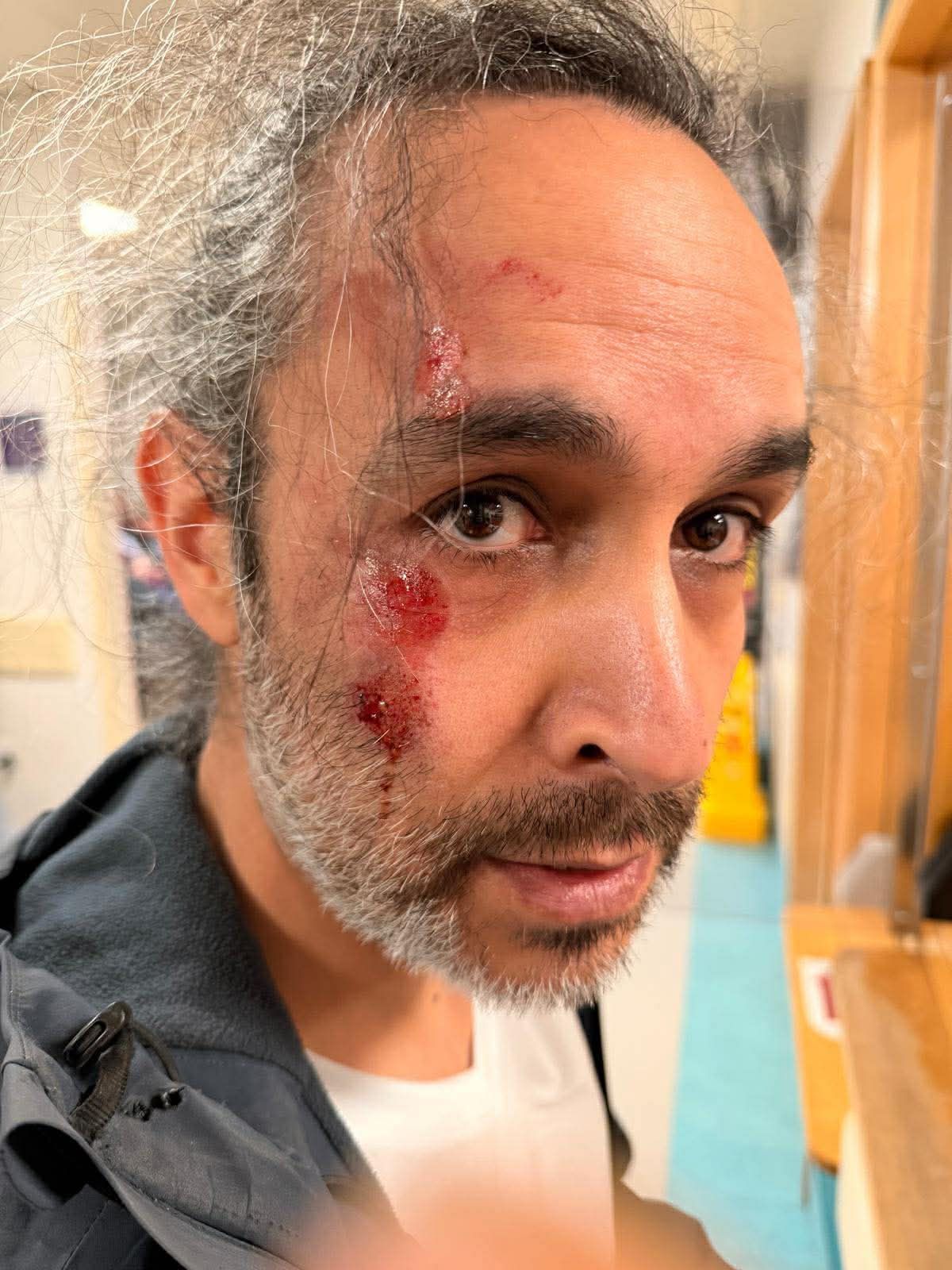 Mustafa Duman shows his injuries after an attack from a DoneDeal buyer