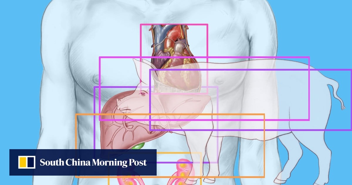 China performs world’s first combined transplant of pig liver and kidney to human