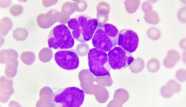 Study explains how leukemia creates inflammatory lung environments