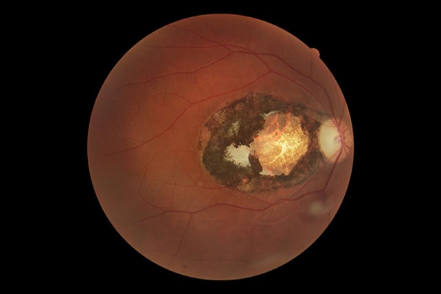 Macular lesion (scar) due to congenital toxoplasmosis