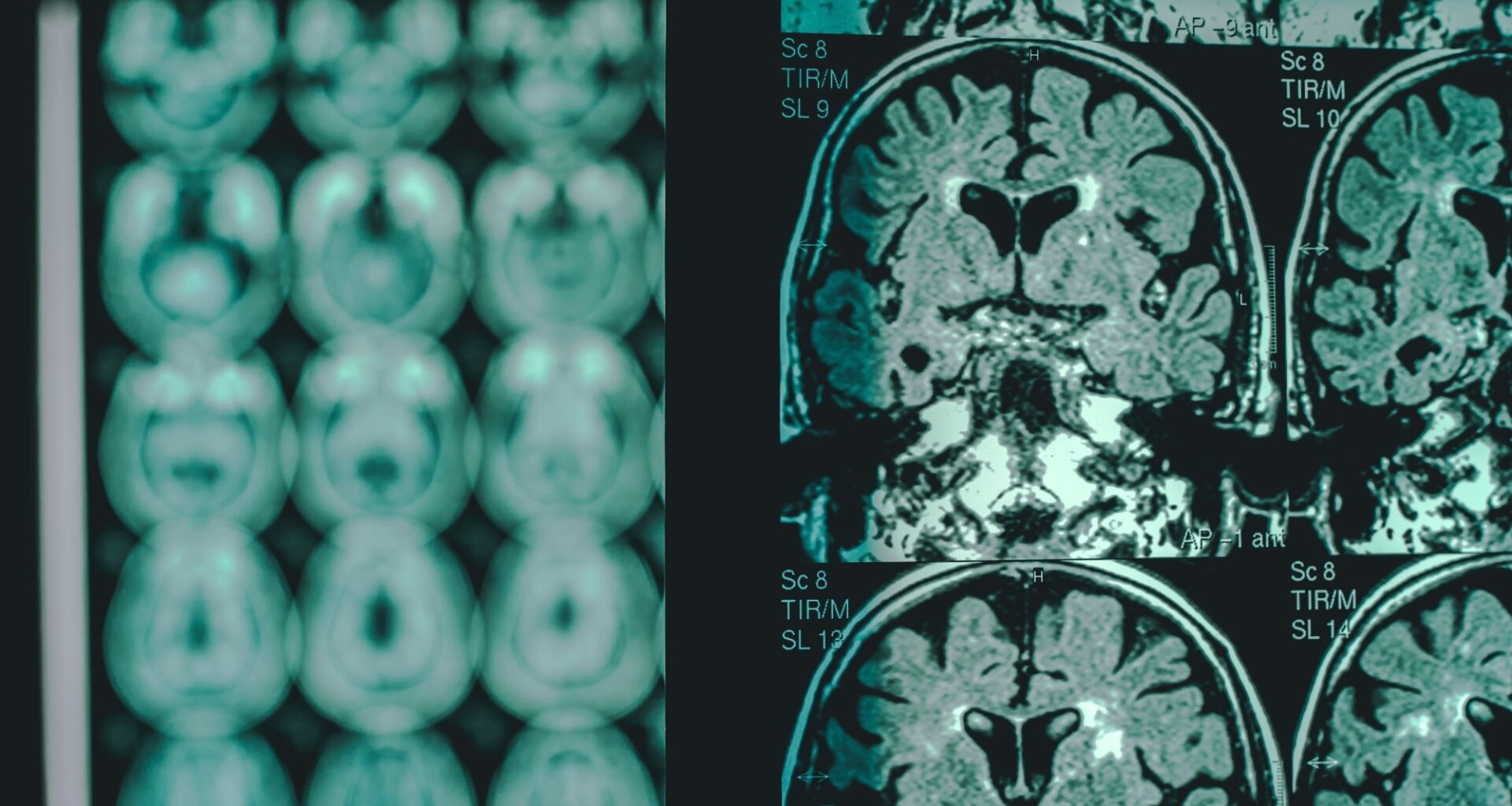 Study: Hyperglycosylation is a metabolic driver of Alzheimer’s disease. Image Credit: Atthapon Raksthaput / Shutterstock