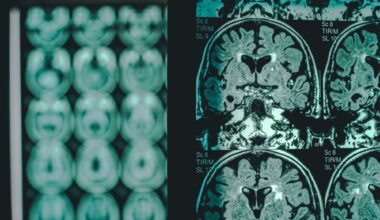 Study: Hyperglycosylation is a metabolic driver of Alzheimer’s disease. Image Credit: Atthapon Raksthaput / Shutterstock