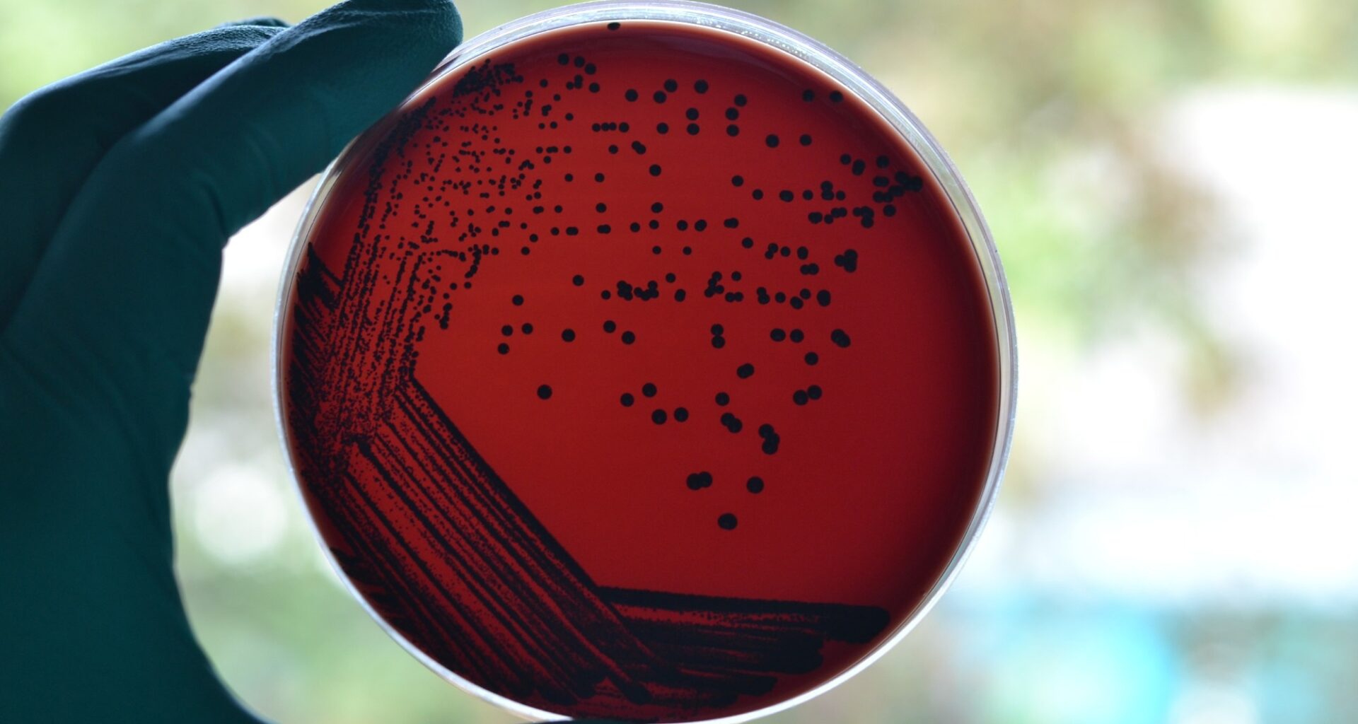Australia’s diphtheria outbreak shows why boosters, antibiotics, and better housing all matter