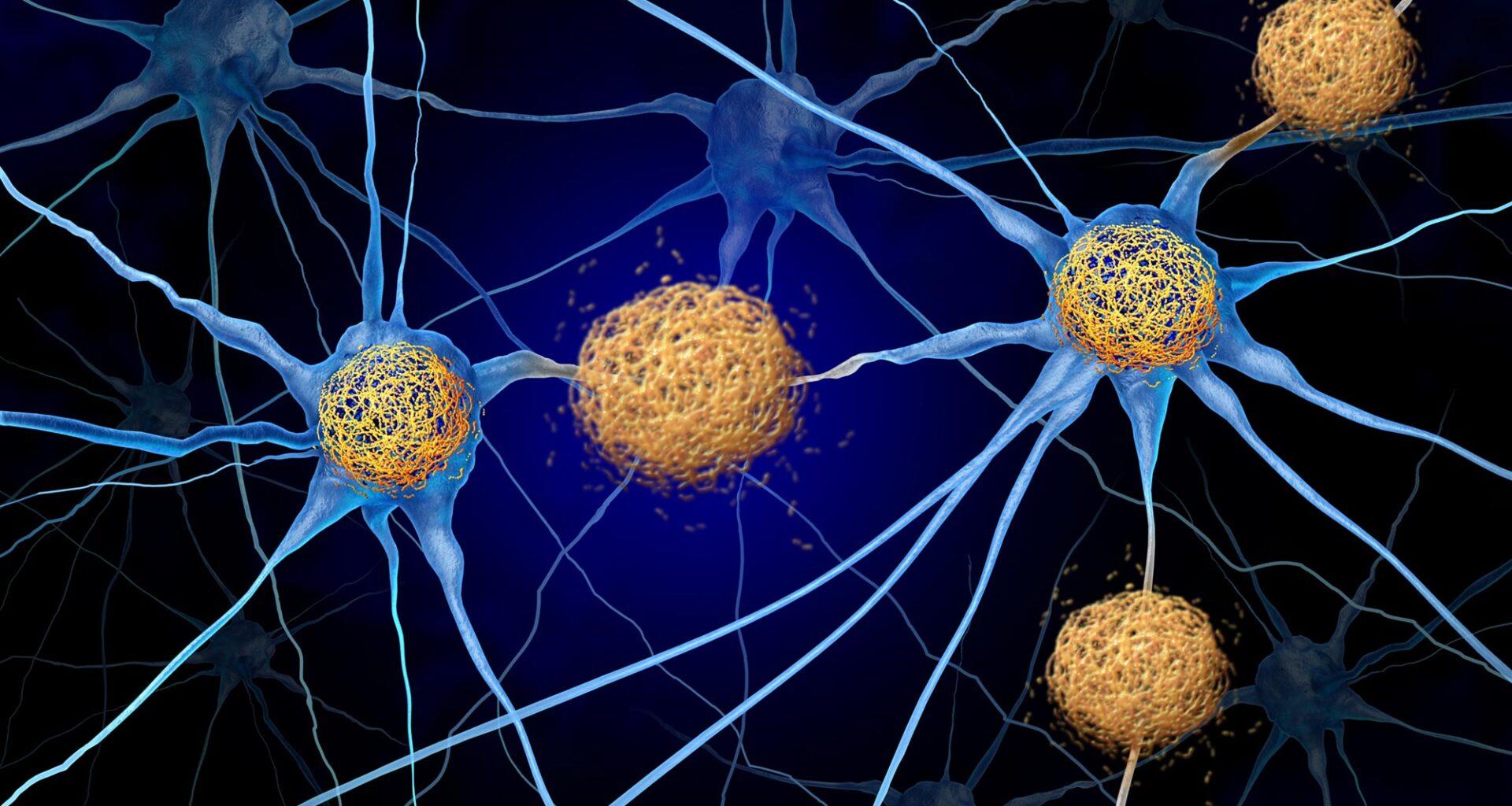 Tau Tangles Amyloid Beta Neuron Cells Brain Alzheimers Dementia