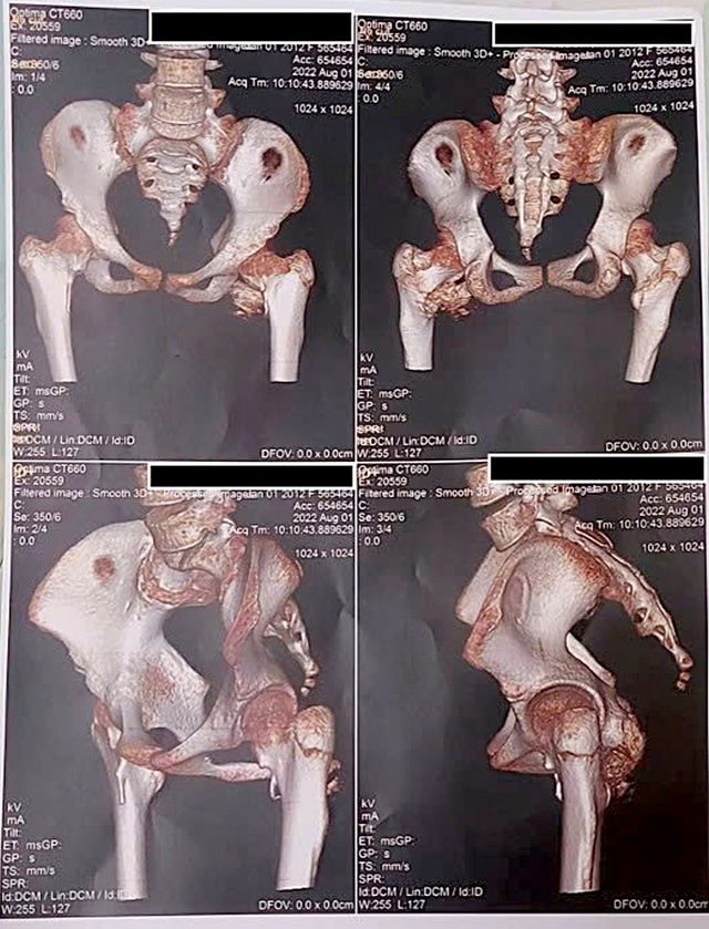 Vietnam doctors diagnose country’s 1st confirmed case of rare ‘stone man syndrome’ - Ảnh 2. Vietnam doctors diagnose country’s 1st confirmed case of rare ‘stone man syndrome’ - Ảnh 2.
