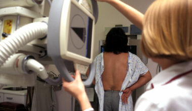 Irish researchers find AI can help determine if breast cancer patients need chemotherapy