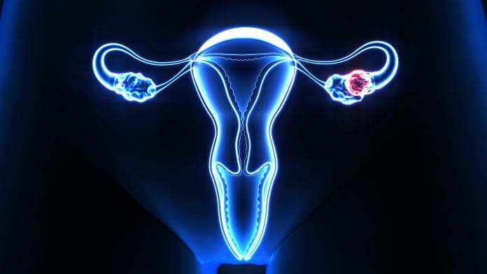X-ray view showing human female reproductive system with focus on uterus and an ovarian cyst in blue and red colors