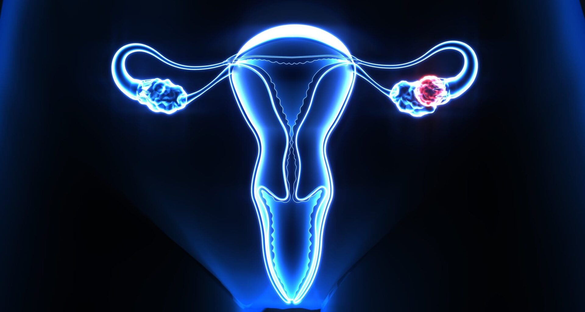 X-ray view showing human female reproductive system with focus on uterus and an ovarian cyst in blue and red colors