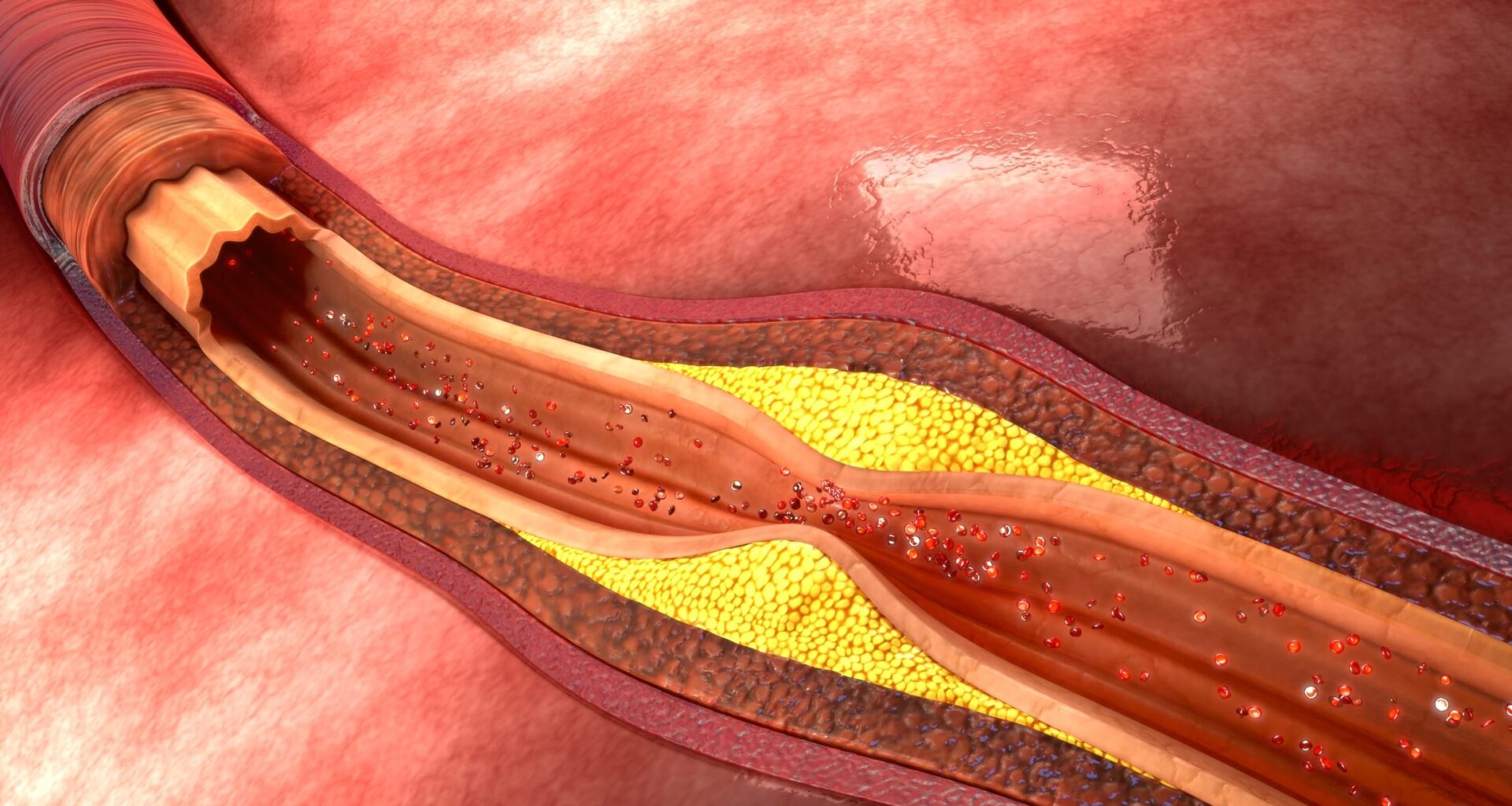 New Blood Test Method Improves HDL Function Analysis in Heart Disease