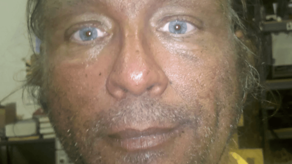 Man who's injected Melanotan II for years shares before and after photos