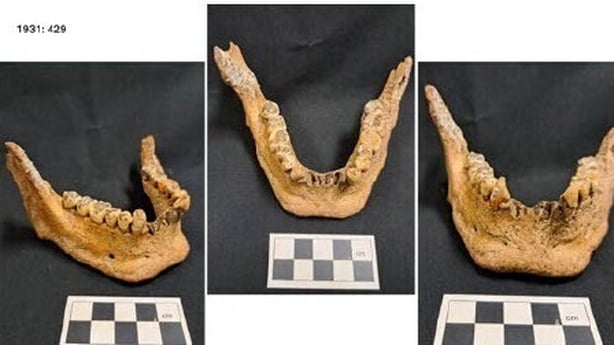 A composite image showing the jaw bone of the human remains.